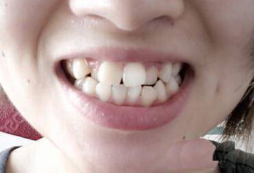 门牙有缝隙面相_牙齿有缝隙的人面相_面相牙齿有缝隙