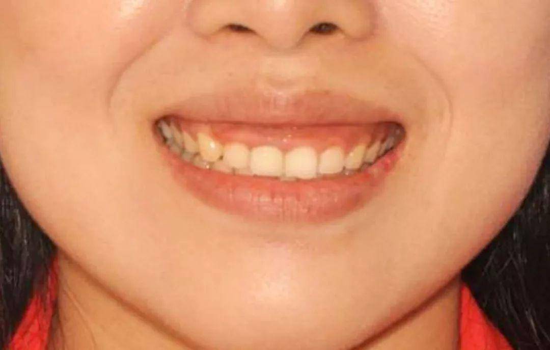 面相中的牙齿_牙齿整齐的人面相_牙齿参差不齐 面相