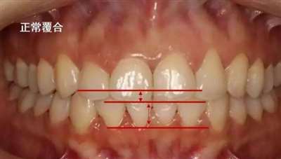 深覆合牙齿_牙齿深覆合矫正前后对比_牙齿深覆合的面相