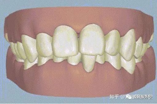 牙齿深覆合矫正后脸型_牙齿深覆合的面相_牙齿深覆合矫正前后对比