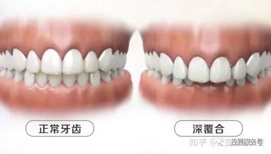 牙齿深覆合的面相_牙齿深覆合矫正前后对比_牙齿深覆合矫正后脸型