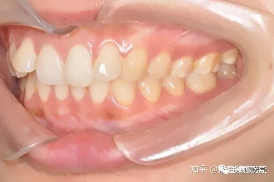 牙齿深覆合矫正前后对比_牙齿深覆合矫正后脸型_牙齿深覆合的面相