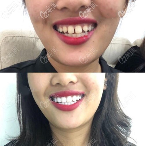 牙齿算命吗？女人大门牙有缝的面相好吗？