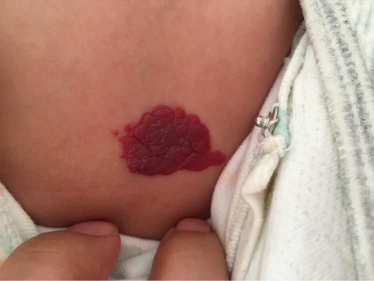 婴幼儿血管瘤对宝宝有哪些影响？川蜀血管病医院