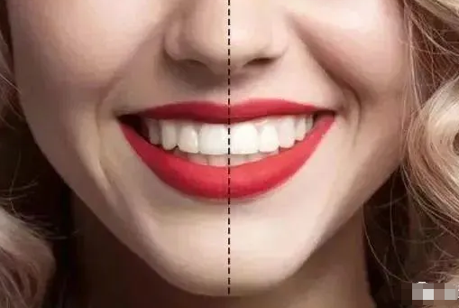 什么样的牙齿焦黄最好？看看你是哪种？