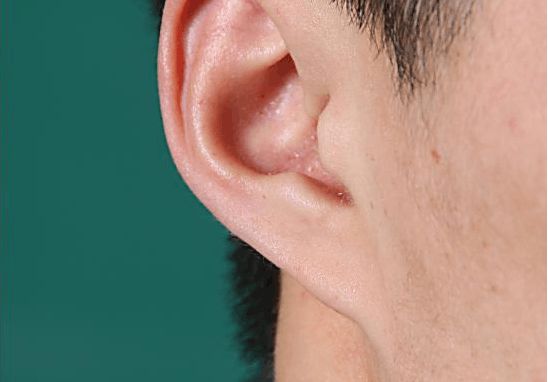 （李向东）耳朵的特征，看看你有没有？